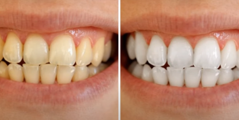 Yellow Teeth Home Remedies
