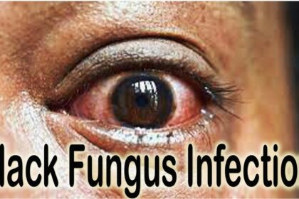 Symptoms of Black Fungus