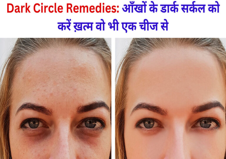 Dark Circle Remedies