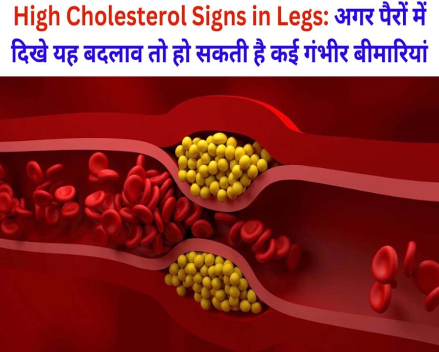 High Cholesterol Signs in Legs