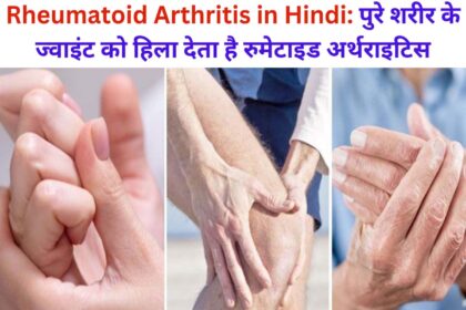 Rheumatoid Arthritis in Hindi