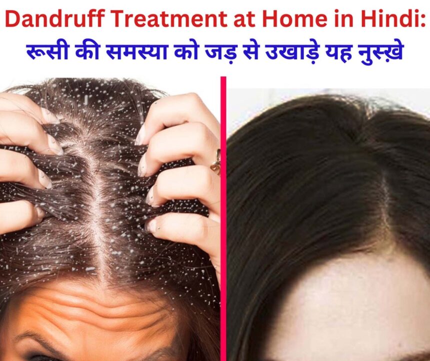 Dandruff Treatment at Home in Hindi